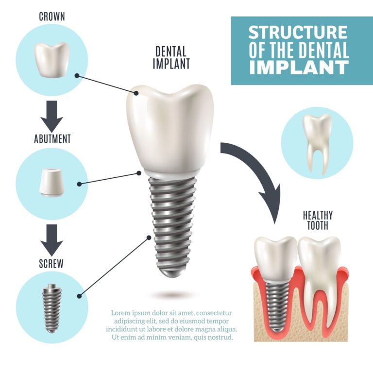 All-On-4 Dental Implant